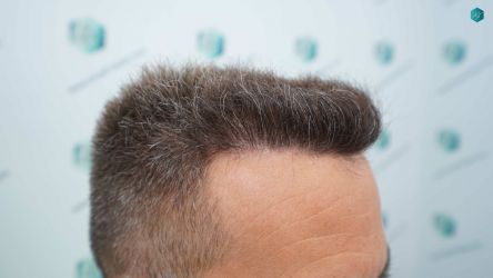 Injerto Capilar Técnica FUE Grafts 3021 (6242 Pelos) 45 42 RESULTADOS A LOS 12 MESES