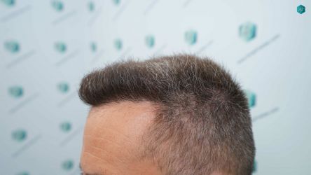 Injerto Capilar Técnica FUE Grafts 3021 (6242 Pelos) 46 46 RESULTADOS A LOS 12 MESES
