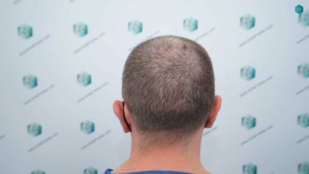 Injerto Capilar Técnica FUE Grafts 3021 (6242 Pelos) 6 5 ANTES DEL TRASPLANTE CAPILAR