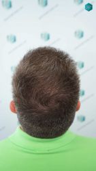 Injerto Capilar Técnica FUE Grafts 3021 (6242 Pelos) 47 52 RESULTADOS A LOS 12 MESES