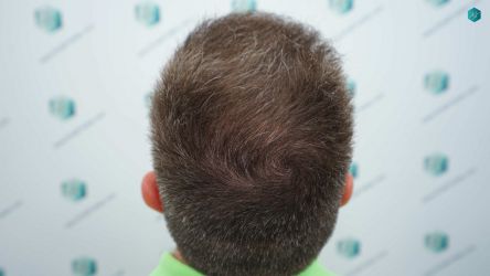 Injerto Capilar Técnica FUE Grafts 3021 (6242 Pelos) 48 53 RESULTADOS A LOS 12 MESES
