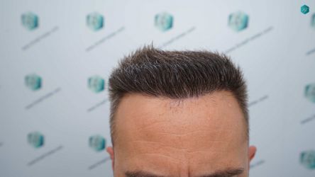 Injerto Capilar Técnica FUE Grafts 3021 (6242 Pelos) 49 55 RESULTADOS A LOS 12 MESES