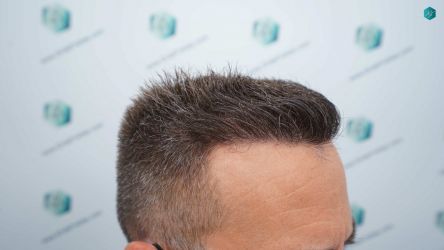 Injerto Capilar Técnica FUE Grafts 3021 (6242 Pelos) 50 56 RESULTADOS A LOS 12 MESES