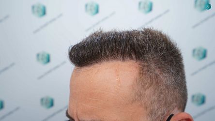 Injerto Capilar Técnica FUE Grafts 3021 (6242 Pelos) 51 58 RESULTADOS A LOS 12 MESES