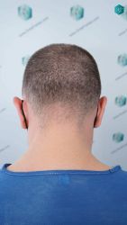 Injerto Capilar Técnica FUE Grafts 3021 (6242 Pelos) 7 ANTES DEL TRASPLANTE CAPILAR