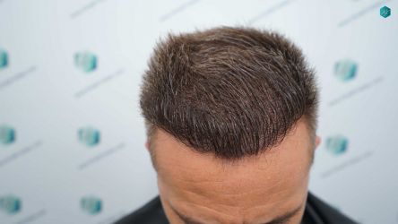 Injerto Capilar Técnica FUE Grafts 3021 (6242 Pelos) 52 64 RESULTADOS A LOS 12 MESES