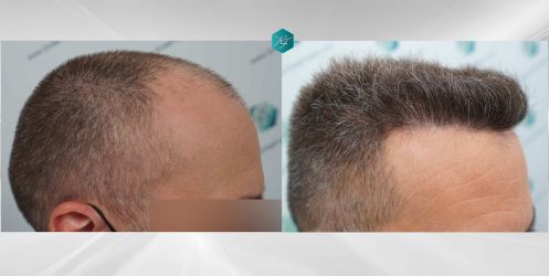 Injerto Capilar Técnica FUE Grafts 3021 (6242 Pelos) 53 66 COMPARATIVAS