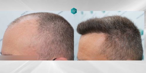 Injerto Capilar Técnica FUE Grafts 3021 (6242 Pelos) 54 67 COMPARATIVAS