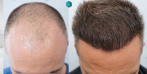 Injerto Capilar Técnica FUE Grafts 3021 (6242 Pelos) 56 69 COMPARATIVAS