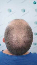 Injerto Capilar Técnica FUE Grafts 3021 (6242 Pelos) 8 7 ANTES DEL TRASPLANTE CAPILAR