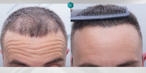 Injerto Capilar Técnica FUE Grafts 3021 (6242 Pelos) 57 70 COMPARATIVAS