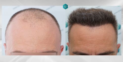 Injerto Capilar Técnica FUE Grafts 3021 (6242 Pelos) 58 71 COMPARAIVAS