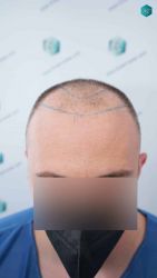 Injerto Capilar Técnica FUE Grafts 3021 (6242 Pelos) 9 LINEA DE INJERTO