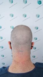 14 DISENO INJERTO CAPILAR