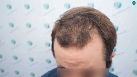 5 ANTES DEL TRASPLANTE CAPILAR