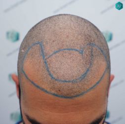 14 DISENO LINEA INJERTO 1
