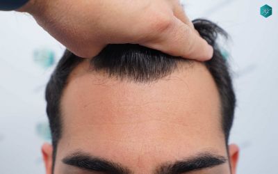 5 ANTES DEL TRAPSLANTE CAPILAR