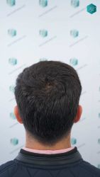 56 RESULTADOS A LOS 12 MESES