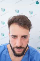 1 ANTES TRASPLANTE