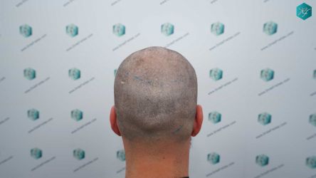 10 LINEA INJERTO