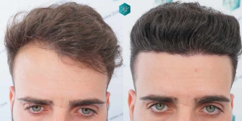 34 ANTES Y DESPUES TRASPLANTE