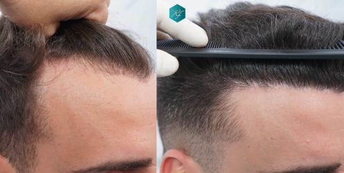 35 ANTES Y DESPUES TRASPLANTE