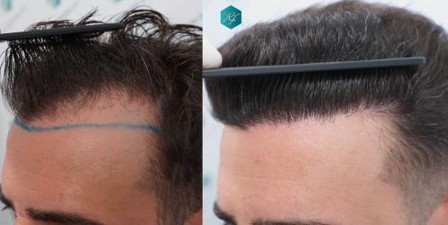 36 ANTES Y DESPUES TRASPLANTE