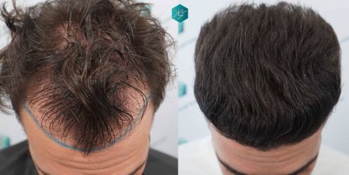 38 ANTES Y DESPUES TRASPLANTE