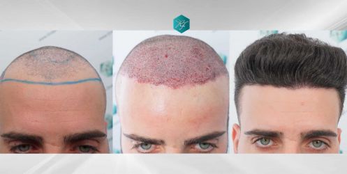 39 ANTES Y DESPUES TRASPLANTE