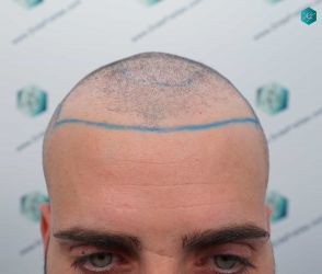 9 LINEA INJERTO