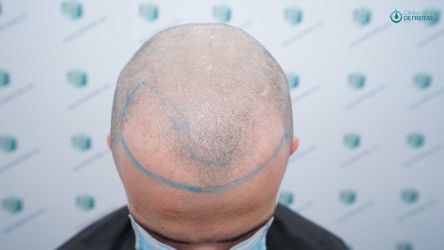 13 DISEÑO LINEA INJERTO
