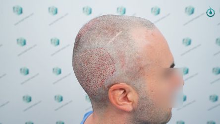 Injerto Capilar Frontal Coronilla Técnica FUE Grafts 4818 (11085 pelos) 11 13 TRASPLANTE CAPILAR