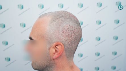 Injerto Capilar Frontal Coronilla Técnica FUE Grafts 4818 (11085 pelos) 12 14 TRASPLANTE CAPILAR