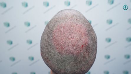 Injerto Capilar Frontal Coronilla Técnica FUE Grafts 4818 (11085 pelos) 14 16 TRASPLANTE CAPILAR