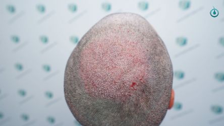 Injerto Capilar Frontal Coronilla Técnica FUE Grafts 4818 (11085 pelos) 15 Injerto Capilar Frontal Coronilla Técnica FUE Grafts 4818 (11085 pelos)