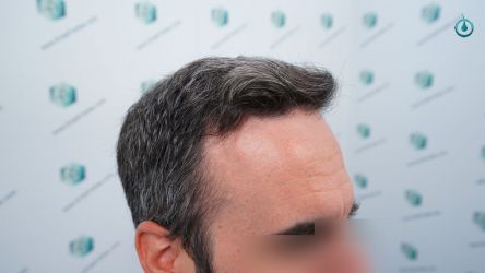 Injerto Capilar Frontal Coronilla Técnica FUE Grafts 4818 (11085 pelos) 1 2 ANTES DEL TRASPLANTE CAPILAR