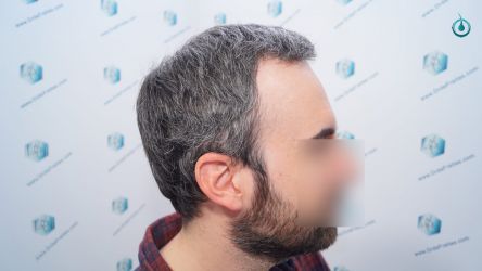 Injerto Capilar Frontal Coronilla Técnica FUE Grafts 4818 (11085 pelos) 17 20 RESULTADOS 3 MESES