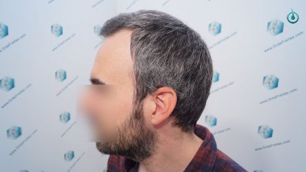 Injerto Capilar Frontal Coronilla Técnica FUE Grafts 4818 (11085 pelos) 18 21 RESULTADOS 3 MESES