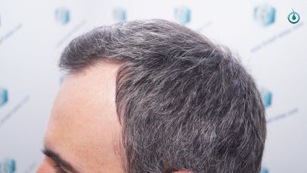 Injerto Capilar Frontal Coronilla Técnica FUE Grafts 4818 (11085 pelos) 19 22 RESULTADOS 3 MESES