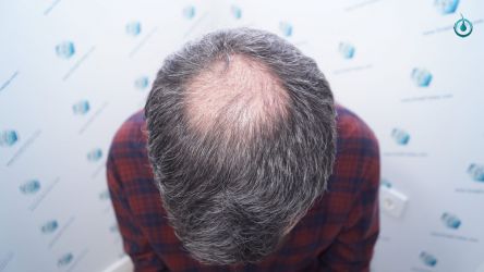 Injerto Capilar Frontal Coronilla Técnica FUE Grafts 4818 (11085 pelos) 20 23 RESULTADOS 3 MESES