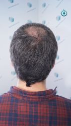 Injerto Capilar Frontal Coronilla Técnica FUE Grafts 4818 (11085 pelos) 21 24 RESULTADOS 3 MESES