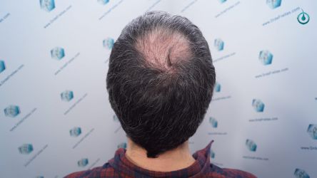 Injerto Capilar Frontal Coronilla Técnica FUE Grafts 4818 (11085 pelos) 22 25 RESULTADOS 3 MESES