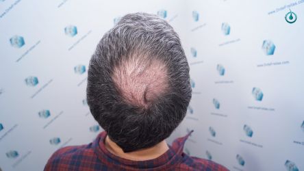 Injerto Capilar Frontal Coronilla Técnica FUE Grafts 4818 (11085 pelos) 23 26 RESULTADOS 3 MESES