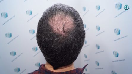 Injerto Capilar Frontal Coronilla Técnica FUE Grafts 4818 (11085 pelos) 24 27 RESULTADOS 3 MESES