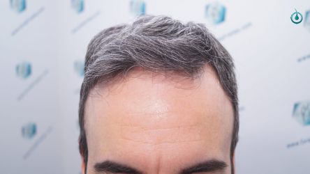 Injerto Capilar Frontal Coronilla Técnica FUE Grafts 4818 (11085 pelos) 25 29 RESULTADOS 6 MESES