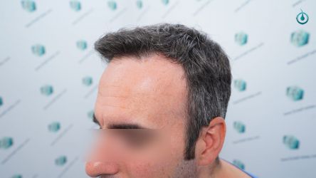 Injerto Capilar Frontal Coronilla Técnica FUE Grafts 4818 (11085 pelos) 3 3 ANTES DEL TRASPLANTE CAPILAR