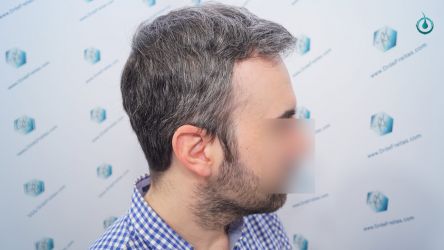 Injerto Capilar Frontal Coronilla Técnica FUE Grafts 4818 (11085 pelos) 26 30 RESULTADOS 6 MESES