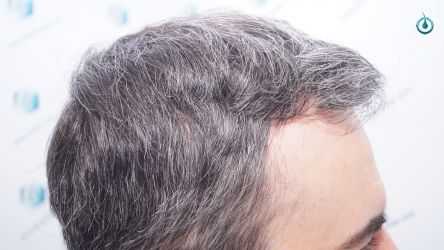 Injerto Capilar Frontal Coronilla Técnica FUE Grafts 4818 (11085 pelos) 27 31 RESULTADOS 6 MESES