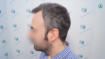 Injerto Capilar Frontal Coronilla Técnica FUE Grafts 4818 (11085 pelos) 28 32 RESULTADOS 6 MESES
