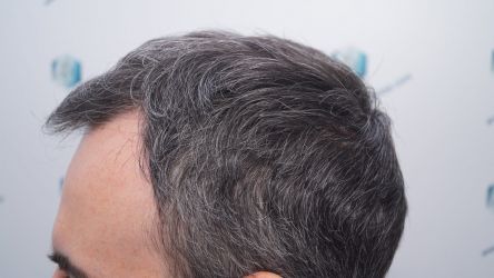 Injerto Capilar Frontal Coronilla Técnica FUE Grafts 4818 (11085 pelos) 29 33 RESULTADOS 6 MESES